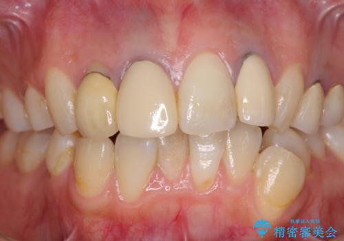 金属で変色した前歯を綺麗にしたい オールセラミッククラウンによる前歯の治療の治療前