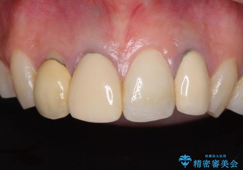金属で変色した前歯を綺麗にしたい　オールセラミッククラウンによる前歯の治療の治療前