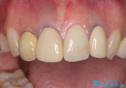 金属で変色した前歯を綺麗にしたい オールセラミッククラウンによる前歯の治療の治療前