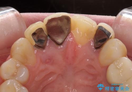 金属で変色した前歯を綺麗にしたい　オールセラミッククラウンによる前歯の治療の治療前