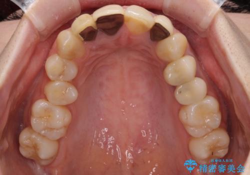 金属で変色した前歯を綺麗にしたい オールセラミッククラウンによる前歯の治療の治療前