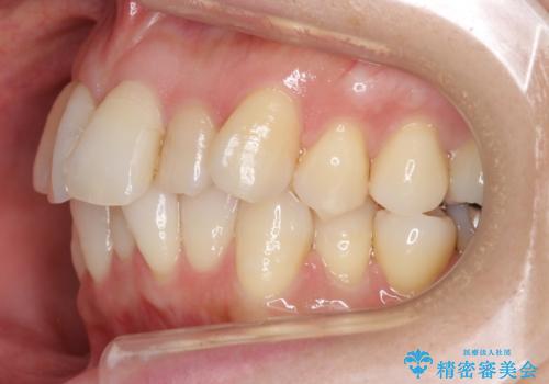 前歯で引っ込んでいる歯がある 他院で矯正200万と言われたの治療前