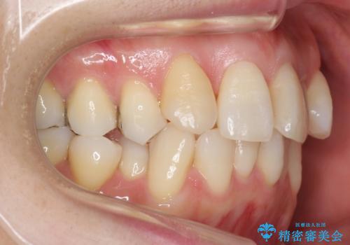 前歯で引っ込んでいる歯がある 他院で矯正200万と言われたの治療前