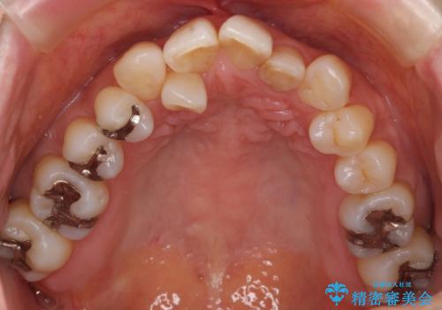 前歯で引っ込んでいる歯がある 他院で矯正200万と言われたの治療前