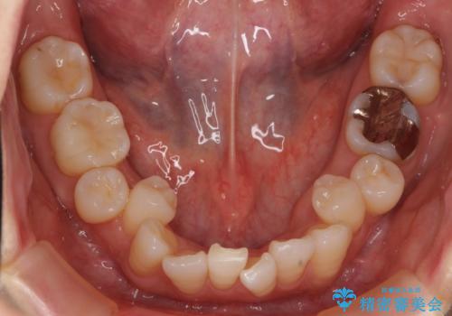 前歯で引っ込んでいる歯がある 他院で矯正200万と言われたの治療前
