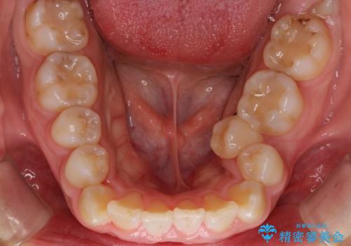 がたがたと出っ歯を直したい ワイヤーによる抜歯矯正の治療前