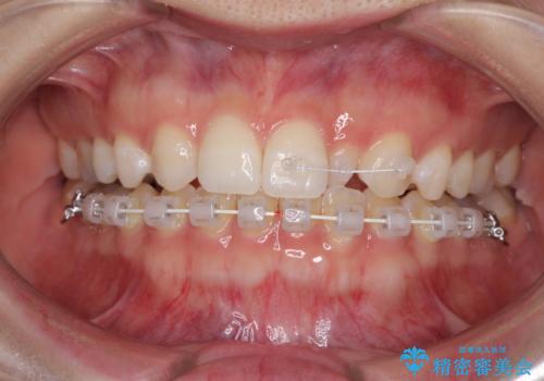 海外転居前に気になる前歯を整えたい 上下前歯の部分矯正の治療中