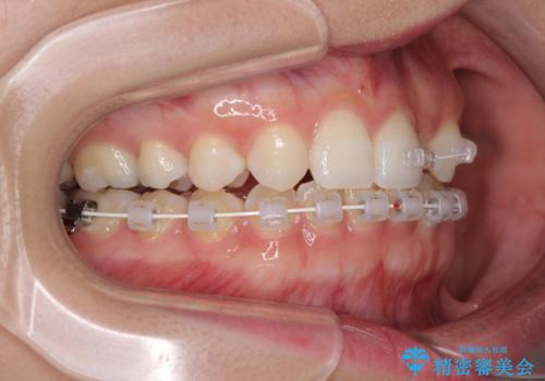 海外転居前に気になる前歯を整えたい 上下前歯の部分矯正の治療中