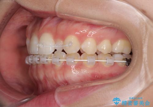 海外転居前に気になる前歯を整えたい 上下前歯の部分矯正の治療中