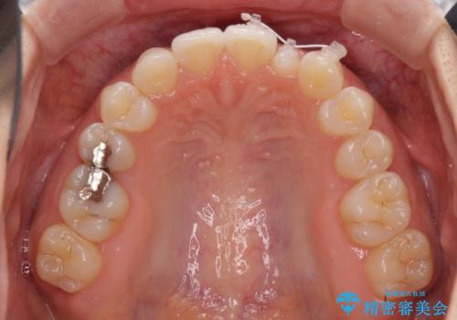 海外転居前に気になる前歯を整えたい　上下前歯の部分矯正の治療中