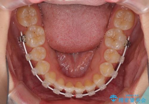 海外転居前に気になる前歯を整えたい 上下前歯の部分矯正の治療中
