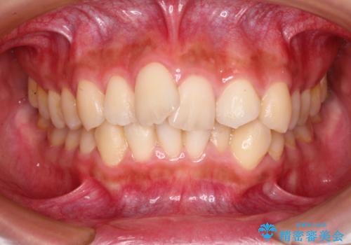 前歯のガタガタを目立たない装置でなおしたい　インビザラインによる目立たない矯正の治療前