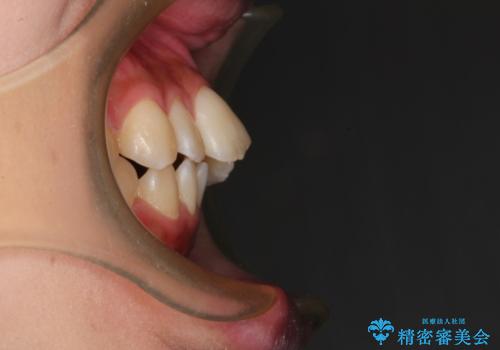 前歯のガタガタを目立たない装置でなおしたい　インビザラインによる目立たない矯正の治療前