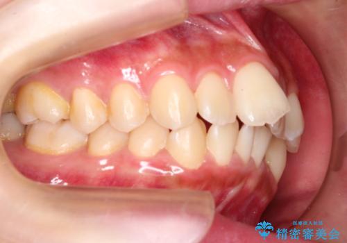 前歯のガタガタを目立たない装置でなおしたい インビザラインによる目立たない矯正の治療前