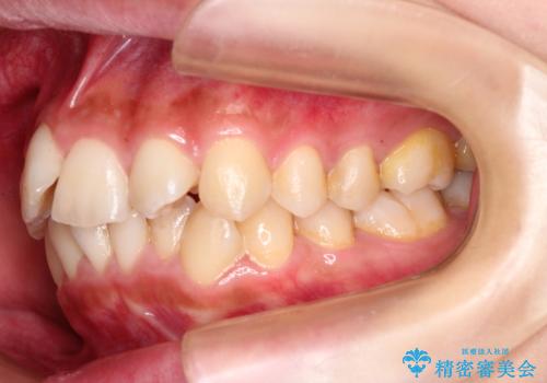 前歯のガタガタを目立たない装置でなおしたい インビザラインによる目立たない矯正の治療前