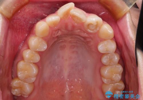 前歯のガタガタを目立たない装置でなおしたい インビザラインによる目立たない矯正の治療前