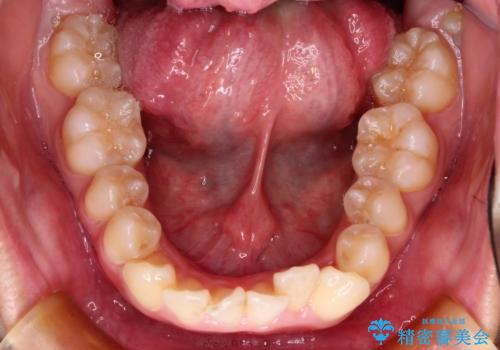前歯のガタガタを目立たない装置でなおしたい インビザラインによる目立たない矯正の治療前