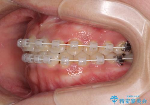 前歯の反対咬合　非抜歯のワイヤー矯正の治療中