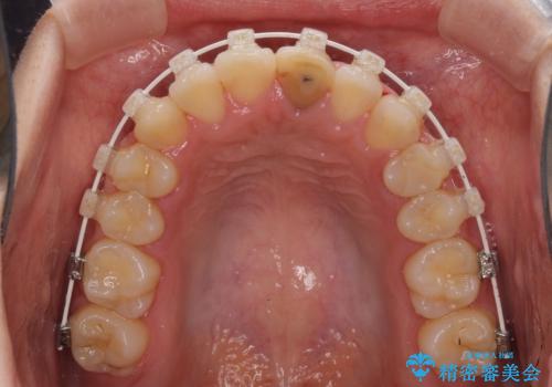 前歯の反対咬合 非抜歯のワイヤー矯正の治療中