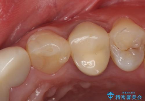 オールセラミッククラウン　歯牙の挺出後の補綴の治療前