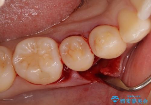 このままでは抜歯と言われた 失われた骨の再生治療 の治療中