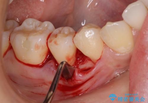 このままでは抜歯と言われた 失われた骨の再生治療 の治療前