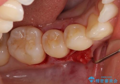このままでは抜歯と言われた 失われた骨の再生治療 の治療中
