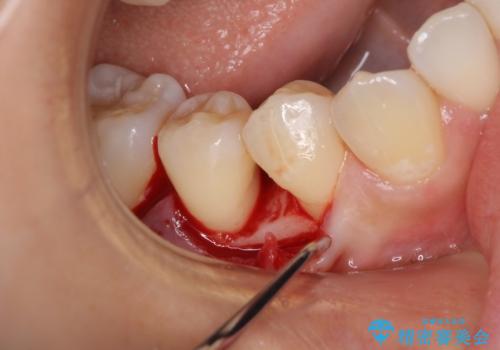 このままでは抜歯と言われた 失われた骨の再生治療 の治療前