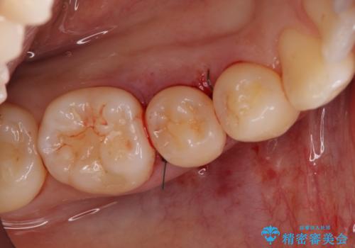 このままでは抜歯と言われた 失われた骨の再生治療 の治療中