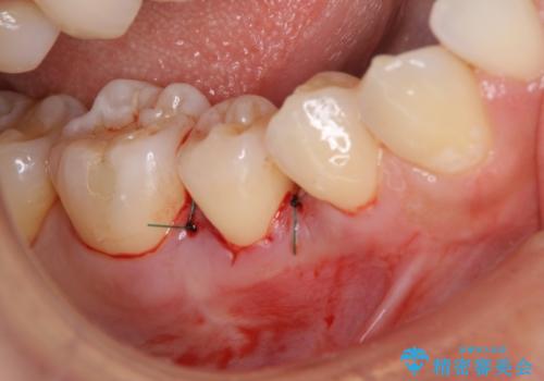 このままでは抜歯と言われた 失われた骨の再生治療 の治療前