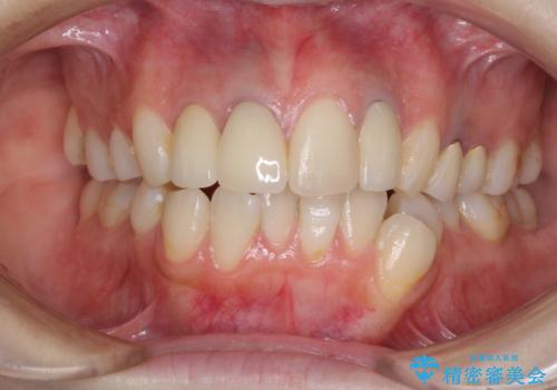金属で変色した前歯を綺麗にしたい オールセラミッククラウンによる前歯の治療の治療後
