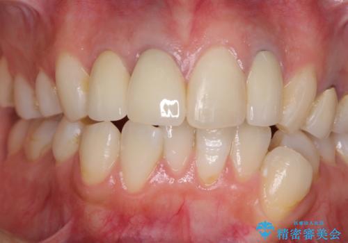 金属で変色した前歯を綺麗にしたい　オールセラミッククラウンによる前歯の治療の治療後