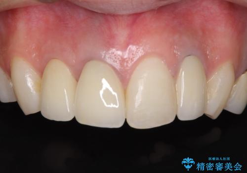 金属で変色した前歯を綺麗にしたい　オールセラミッククラウンによる前歯の治療の症例 治療後