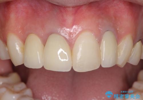 金属で変色した前歯を綺麗にしたい　オールセラミッククラウンによる前歯の治療の治療後