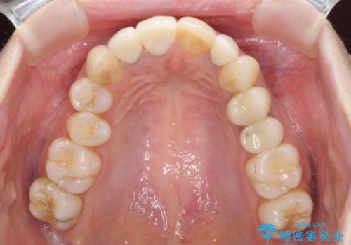 金属で変色した前歯を綺麗にしたい オールセラミッククラウンによる前歯の治療の治療後