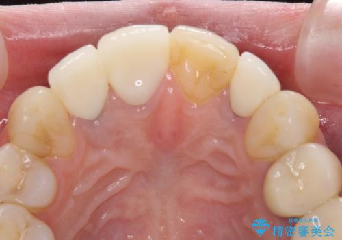 金属で変色した前歯を綺麗にしたい オールセラミッククラウンによる前歯の治療の治療後