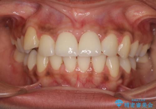 継ぎ接ぎだらけで歯肉も腫れてしまった前歯 オールセラミックの審美歯科治療の治療後