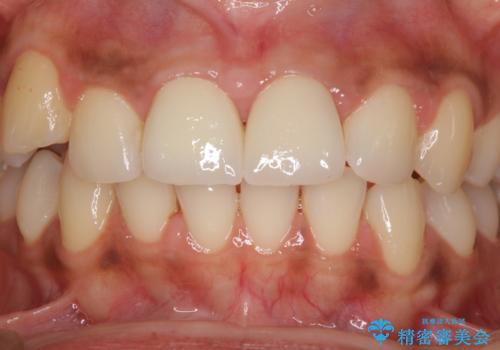 継ぎ接ぎだらけで歯肉も腫れてしまった前歯 オールセラミックの審美歯科治療の治療後