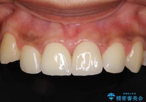 継ぎ接ぎだらけで歯肉も腫れてしまった前歯 オールセラミックの審美歯科治療の症例 治療後