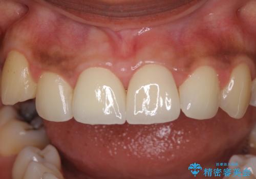 継ぎ接ぎだらけで歯肉も腫れてしまった前歯 オールセラミックの審美歯科治療の治療後