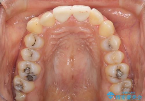 継ぎ接ぎだらけで歯肉も腫れてしまった前歯 オールセラミックの審美歯科治療の治療後