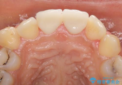 継ぎ接ぎだらけで歯肉も腫れてしまった前歯 オールセラミックの審美歯科治療の治療後