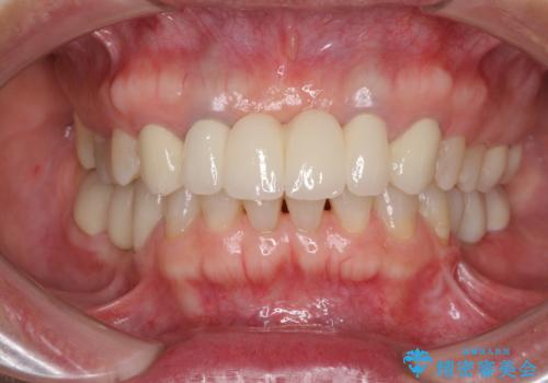 飛行機を利用しての通院 気になる所を全て治療する総合歯科治療の治療後