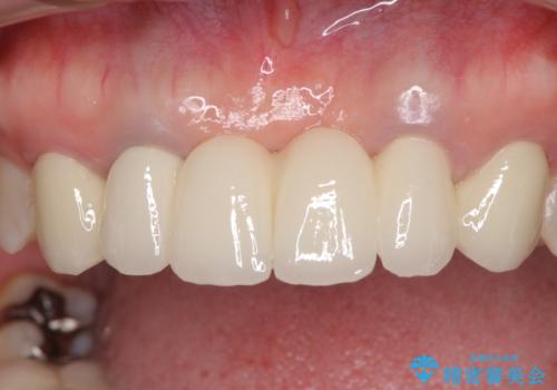 飛行機を利用しての通院 気になる所を全て治療する総合歯科治療の治療後