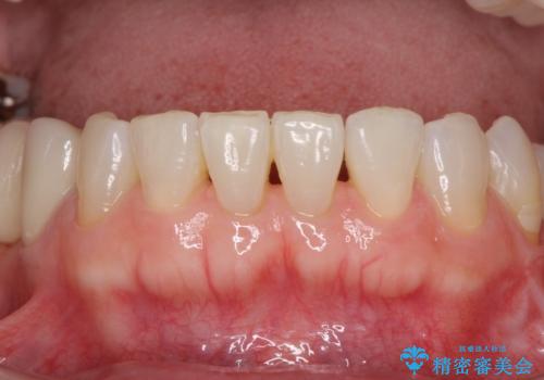 飛行機を利用しての通院 気になる所を全て治療する総合歯科治療の治療後