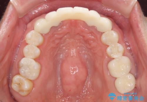 飛行機を利用しての通院 気になる所を全て治療する総合歯科治療の治療後
