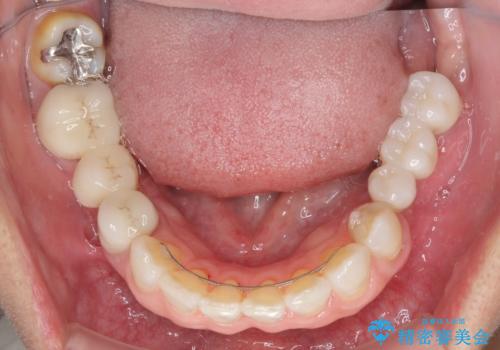 飛行機を利用しての通院 気になる所を全て治療する総合歯科治療の治療後