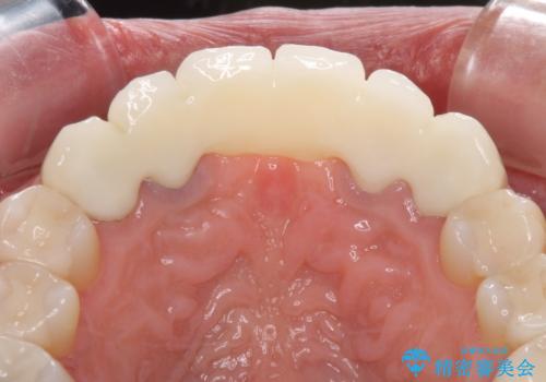 飛行機を利用しての通院 気になる所を全て治療する総合歯科治療の治療後
