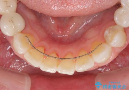 飛行機を利用しての通院 気になる所を全て治療する総合歯科治療の治療後