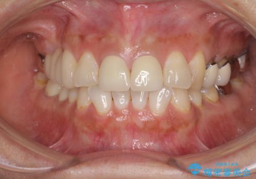 不調和な前歯の審美歯科治療の治療後